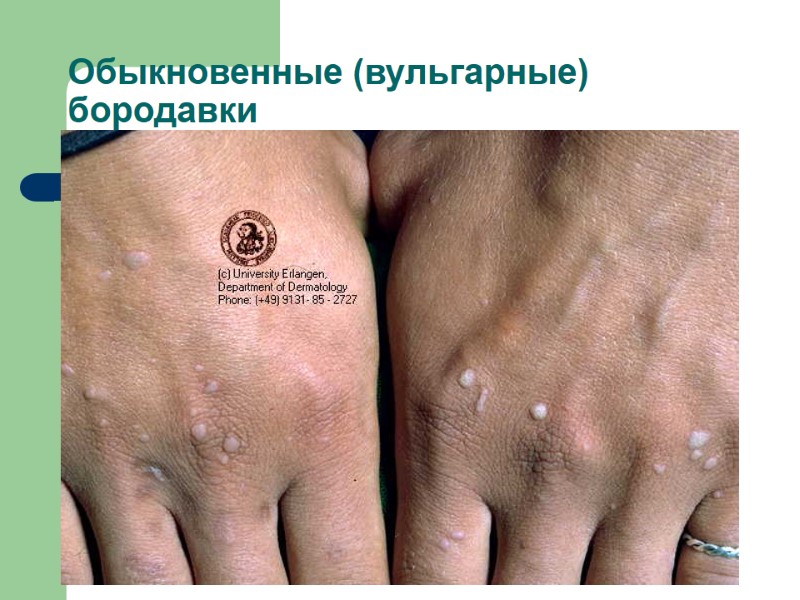 Обыкновенные (вульгарные) бородавки